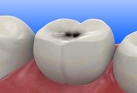 Стоматология – как лечить кариозные зубы