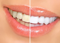 Как сделать зубы белоснежными